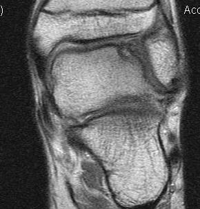 Talus OCD MRI Coronal